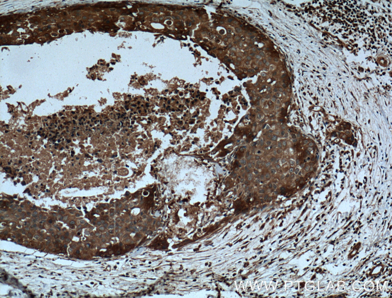 Immunohistochemistry (IHC) staining of human breast cancer tissue using CCL24/Eotaxin 2 Polyclonal antibody (22306-1-AP)