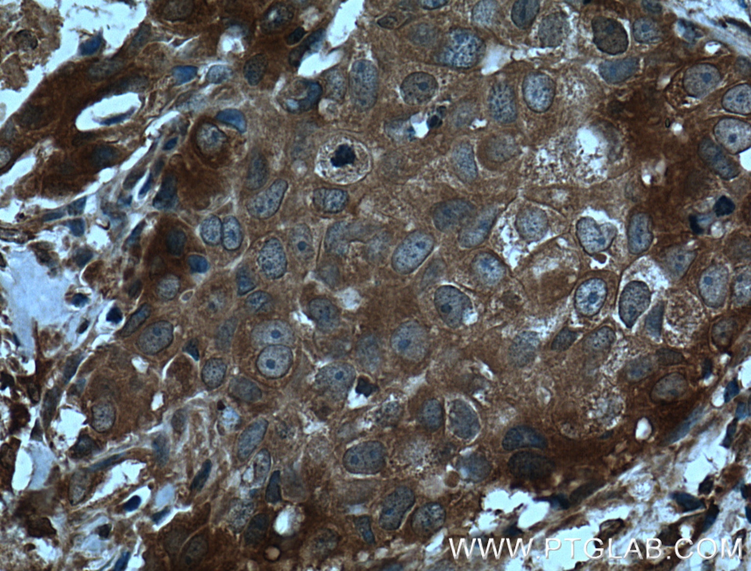 Immunohistochemistry (IHC) staining of human breast cancer tissue using CCL24/Eotaxin 2 Polyclonal antibody (22306-1-AP)