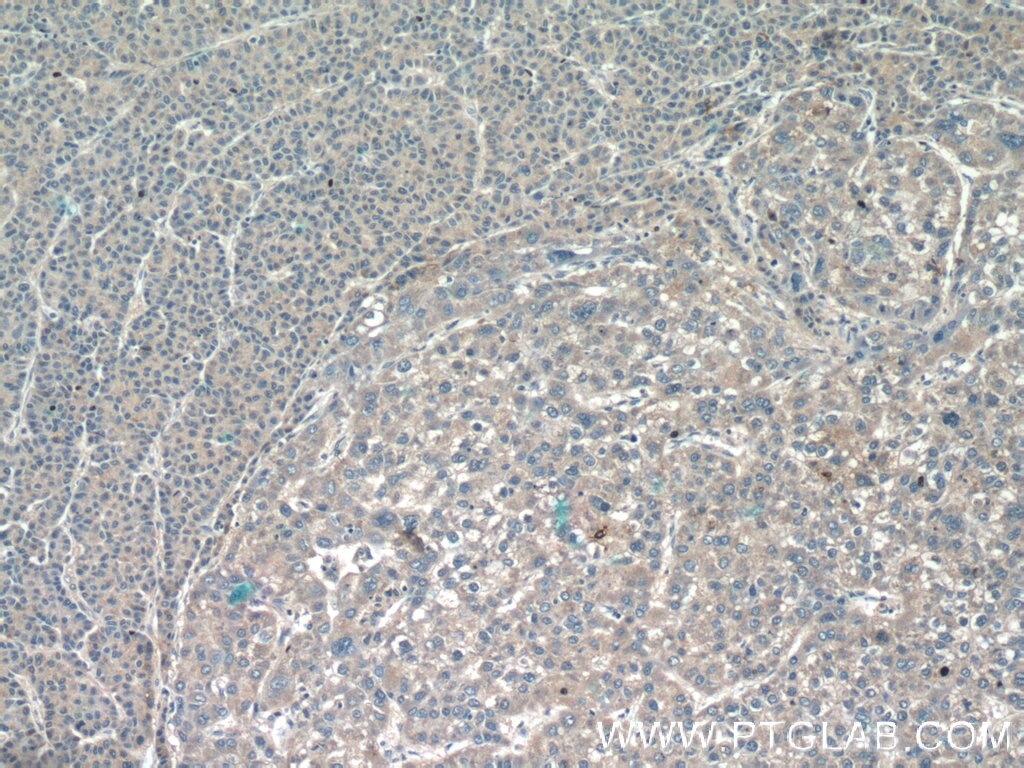 Immunohistochemistry (IHC) staining of human liver cancer tissue using CCL27 Polyclonal antibody (22301-1-AP)