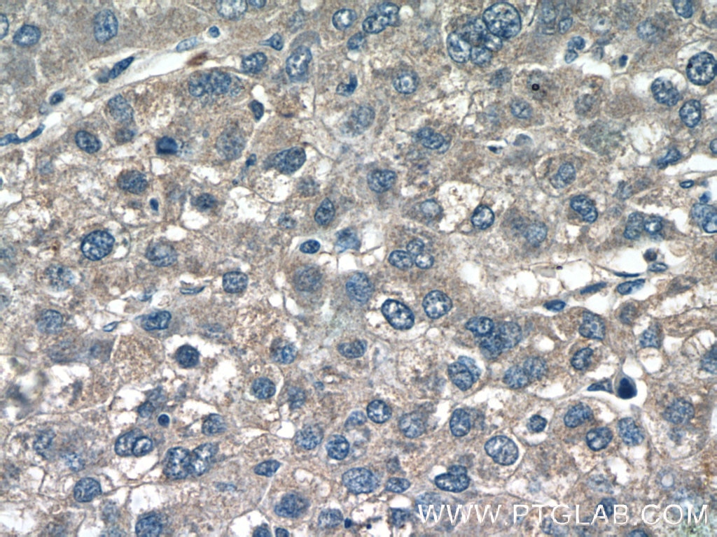 Immunohistochemistry (IHC) staining of human liver cancer tissue using CCL27 Polyclonal antibody (22301-1-AP)