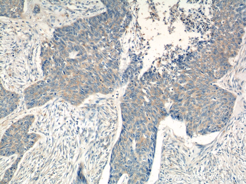 Immunohistochemistry (IHC) staining of human skin cancer tissue using CCL27 Polyclonal antibody (22301-1-AP)