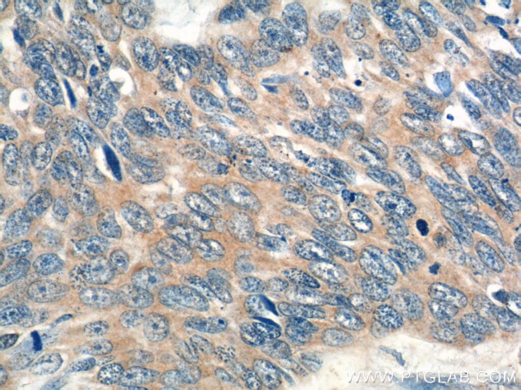 Immunohistochemistry (IHC) staining of human skin cancer tissue using CCL27 Polyclonal antibody (22301-1-AP)