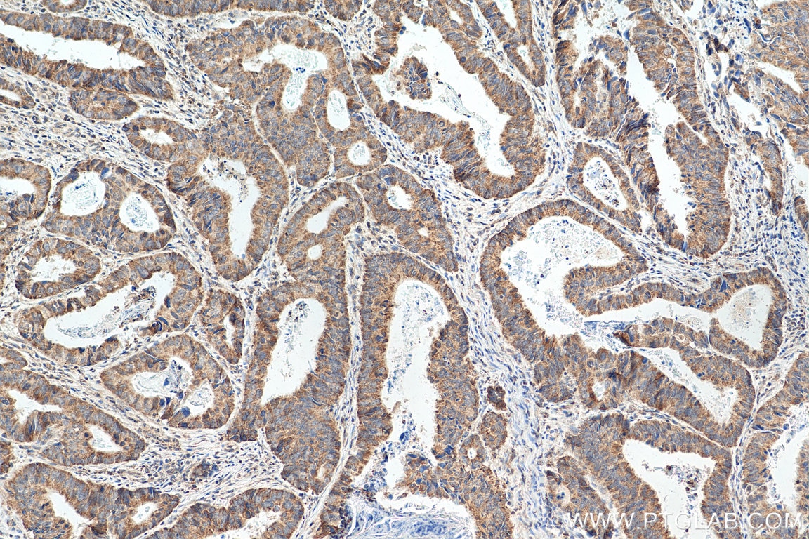 Immunohistochemistry (IHC) staining of human colon cancer tissue using CCL28 Polyclonal antibody (18214-1-AP)