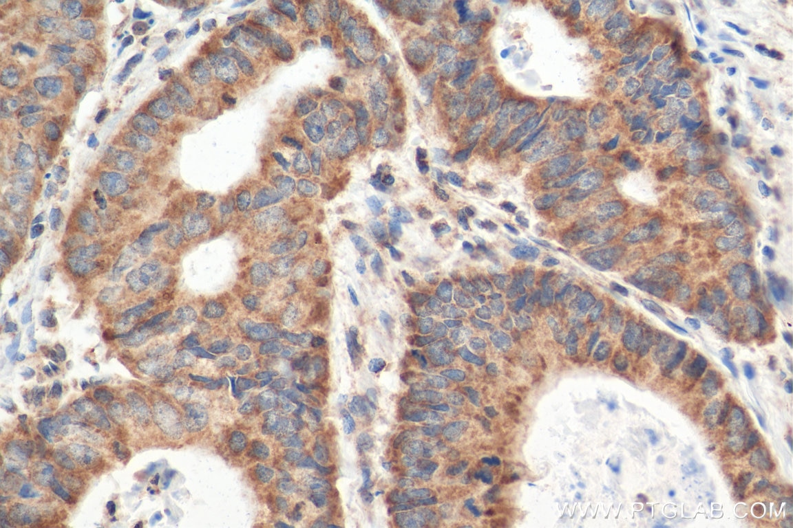 Immunohistochemistry (IHC) staining of human colon cancer tissue using CCL28 Polyclonal antibody (18214-1-AP)