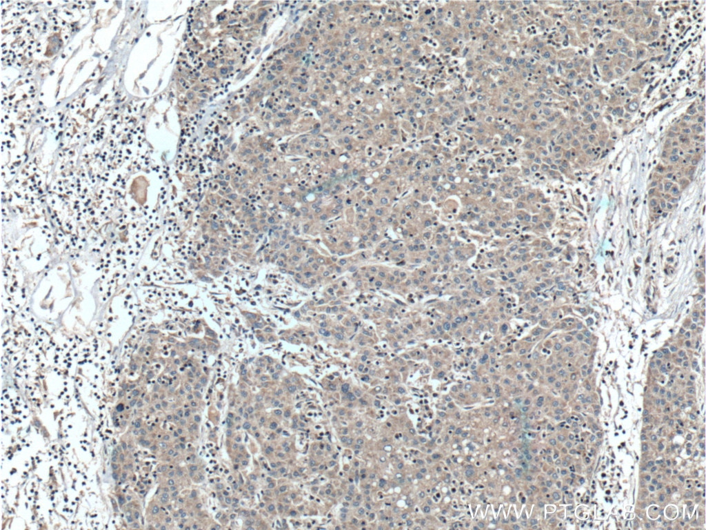 Immunohistochemistry (IHC) staining of human liver cancer tissue using CCM2 Polyclonal antibody (26270-1-AP)