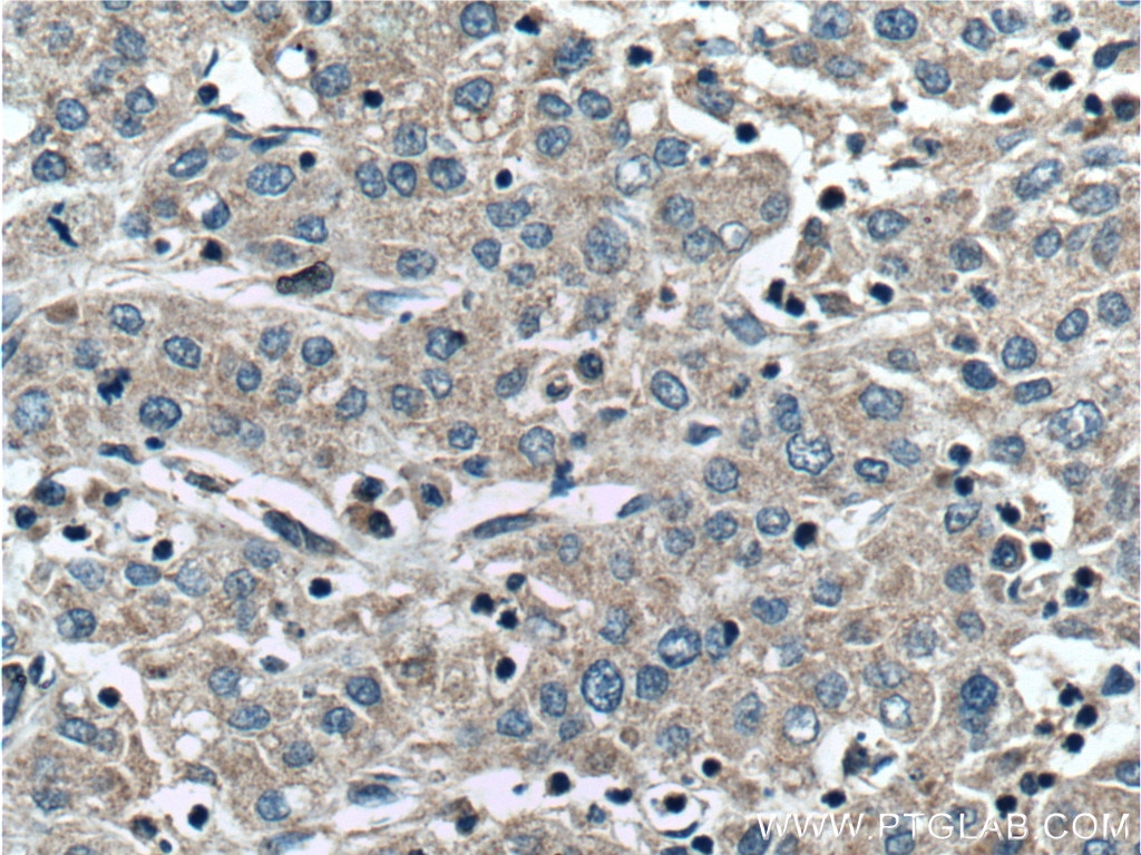 Immunohistochemistry (IHC) staining of human liver cancer tissue using CCM2 Polyclonal antibody (26270-1-AP)