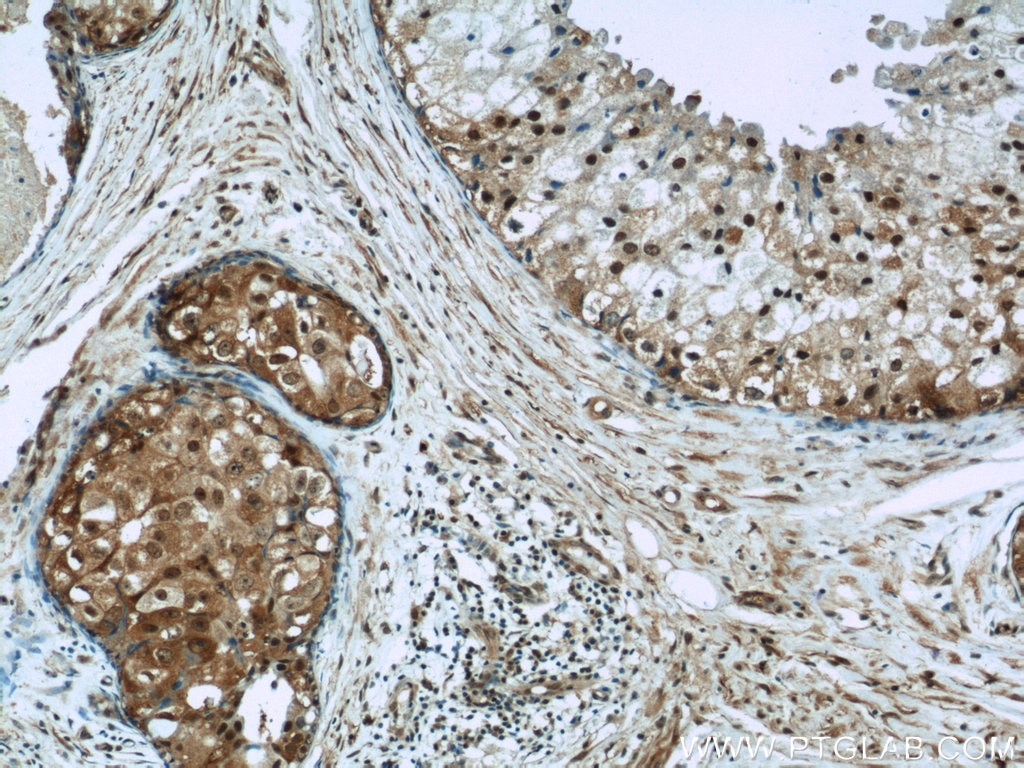 Immunohistochemistry (IHC) staining of human breast cancer tissue using Cyclin A1 Polyclonal antibody (13295-1-AP)
