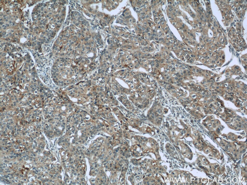 Immunohistochemistry (IHC) staining of human cervical cancer tissue using Cyclin A1 Polyclonal antibody (13295-1-AP)