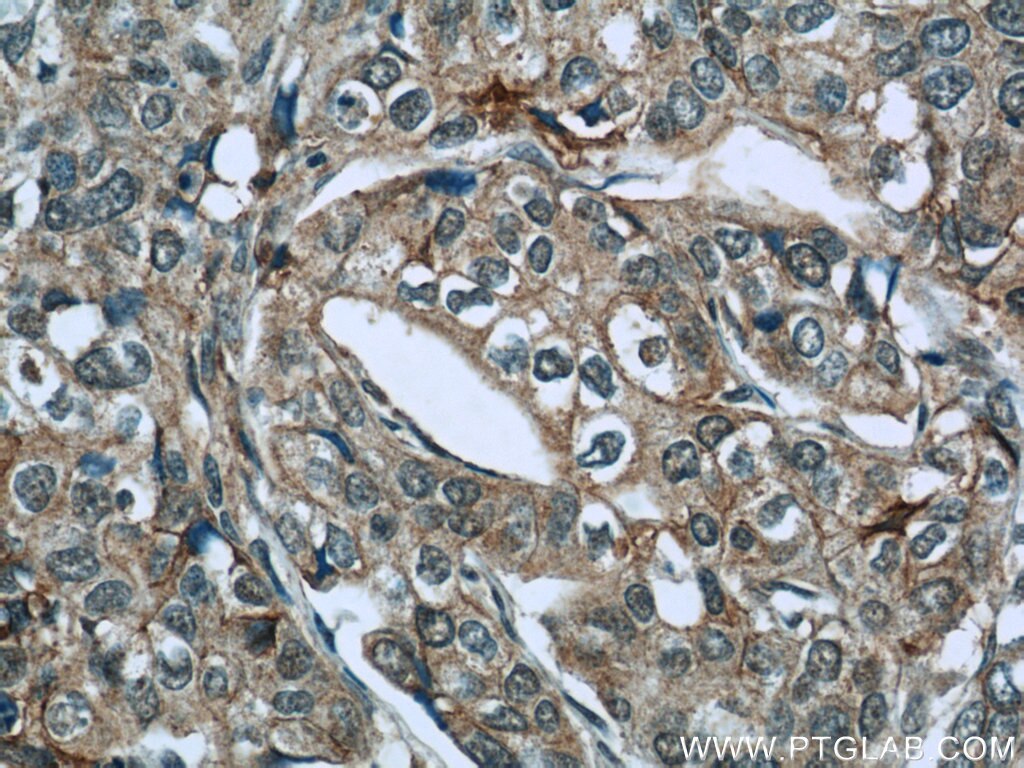 Immunohistochemistry (IHC) staining of human cervical cancer tissue using Cyclin A1 Polyclonal antibody (13295-1-AP)