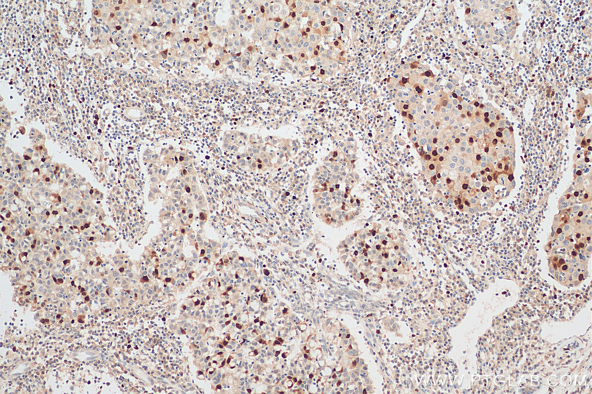 Immunohistochemistry (IHC) staining of human breast cancer tissue using Cyclin A2 Polyclonal antibody (18202-1-AP)