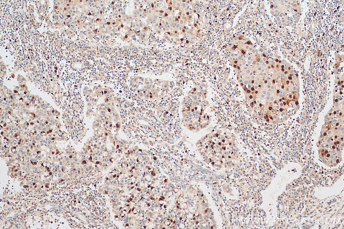 IHC staining of human breast cancer using 18202-1-AP