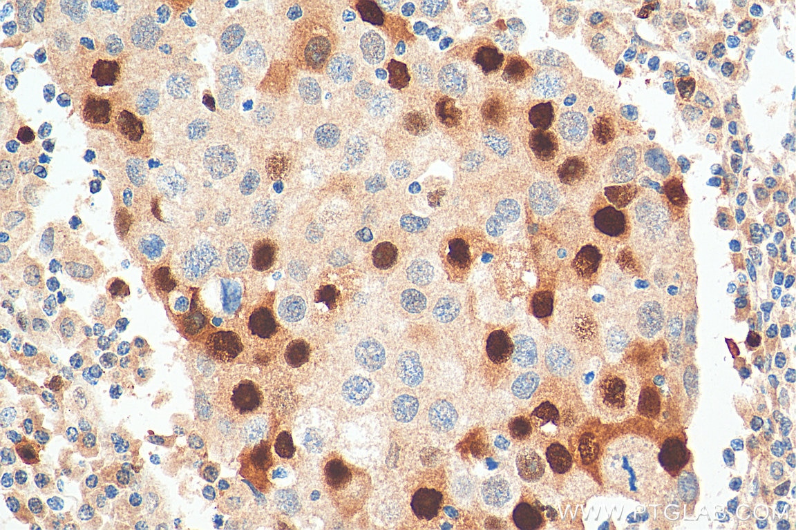 Immunohistochemistry (IHC) staining of human breast cancer tissue using Cyclin A2 Polyclonal antibody (18202-1-AP)