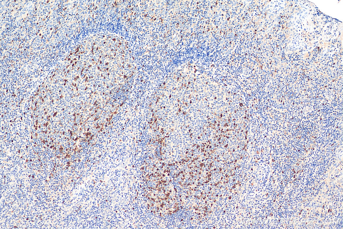 Immunohistochemistry (IHC) staining of human tonsillitis tissue using Cyclin A2 Polyclonal antibody (18202-1-AP)