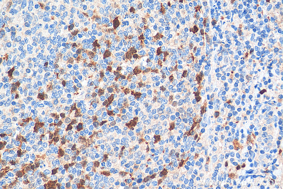 Immunohistochemistry (IHC) staining of human tonsillitis tissue using Cyclin A2 Polyclonal antibody (18202-1-AP)