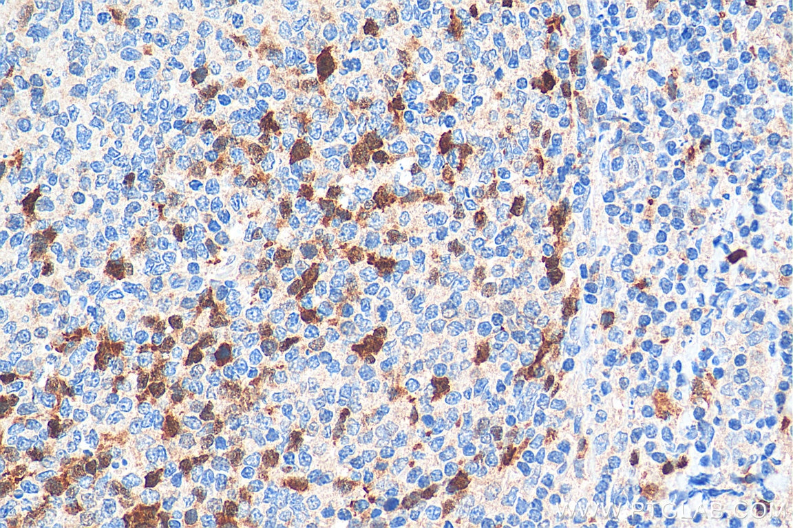 IHC staining of human tonsillitis using 18202-1-AP