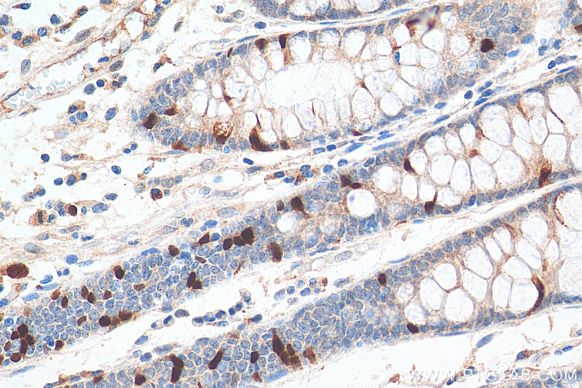 Immunohistochemistry (IHC) staining of human colon cancer tissue using Cyclin A2 Polyclonal antibody (18202-1-AP)