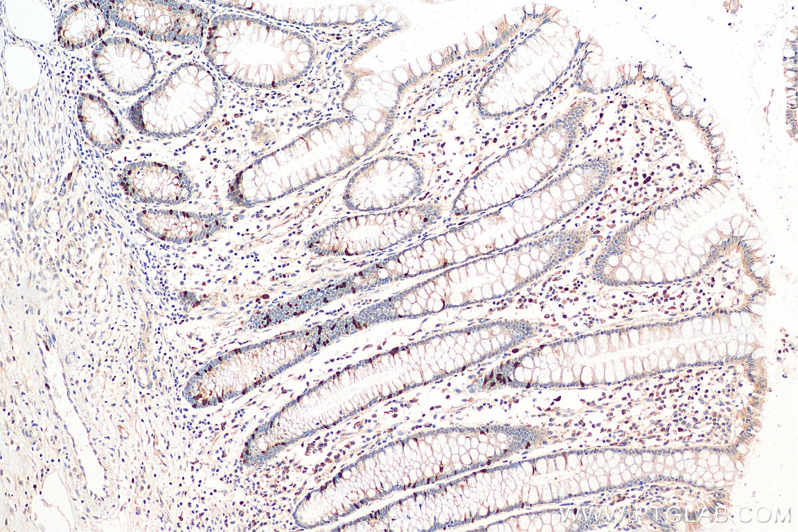Immunohistochemistry (IHC) staining of human colon cancer tissue using Cyclin A2 Polyclonal antibody (18202-1-AP)