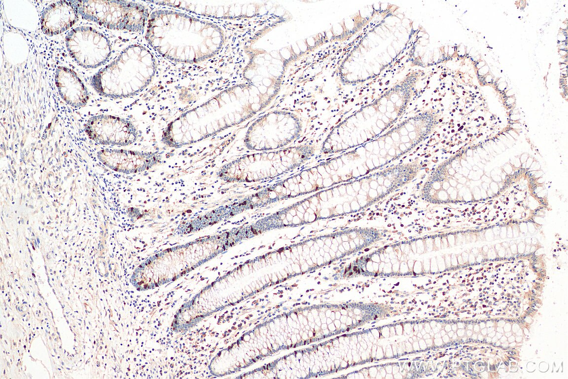 IHC staining of human colon cancer using 18202-1-AP