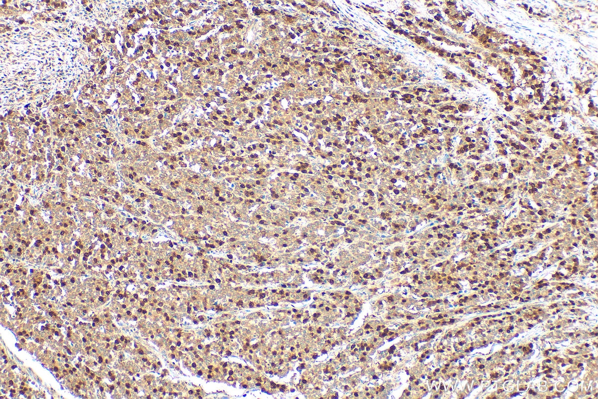 Immunohistochemical analysis of paraffin-embedded human colon cancer tissue slide using 18202-1-AP (Cyclin A2 antibody) at dilution of 1:1000 (under 10x lens). Heat mediated antigen retrieval with Tris-EDTA buffer (pH 9.0). Immunohistochemistry (IHC) staining of human colon cancer tissue using Cyclin A2 Polyclonal antibody (18202-1-AP)