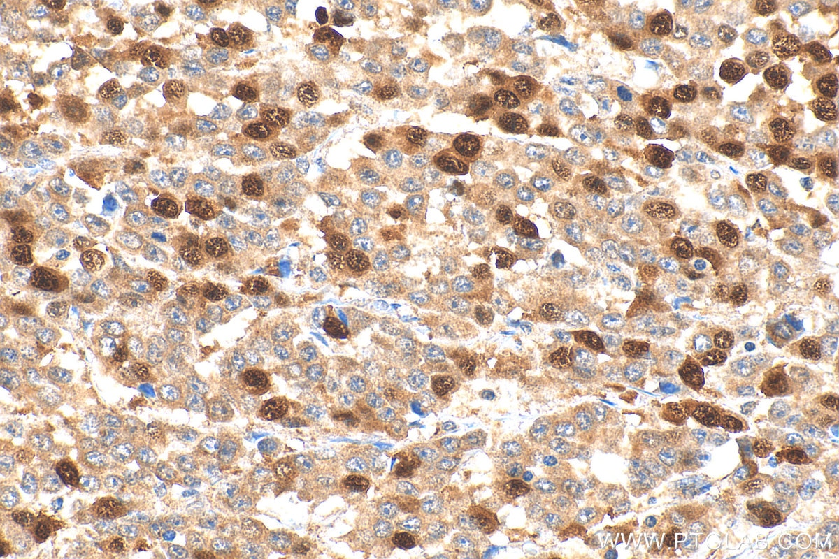 Immunohistochemical analysis of paraffin-embedded human colon cancer tissue slide using 18202-1-AP (Cyclin A2 antibody) at dilution of 1:1000 (under 40x lens). Heat mediated antigen retrieval with Tris-EDTA buffer (pH 9.0). Immunohistochemistry (IHC) staining of human colon cancer tissue using Cyclin A2 Polyclonal antibody (18202-1-AP)
