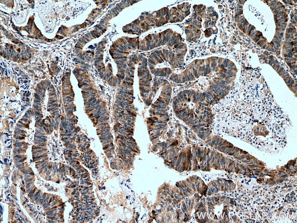 Immunohistochemistry (IHC) staining of human colon cancer tissue using Cyclin B2 Polyclonal antibody (21644-1-AP)