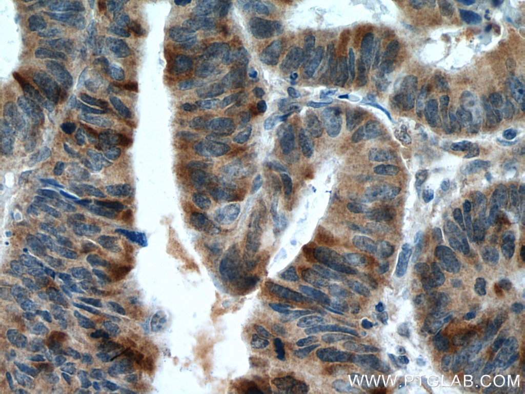 Immunohistochemistry (IHC) staining of human colon cancer tissue using Cyclin B2 Polyclonal antibody (21644-1-AP)