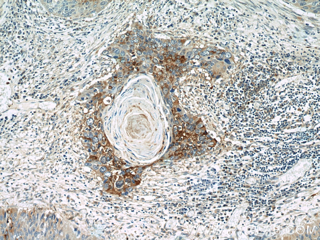 Immunohistochemistry (IHC) staining of human cervical cancer tissue using Cyclin B2 Polyclonal antibody (21644-1-AP)