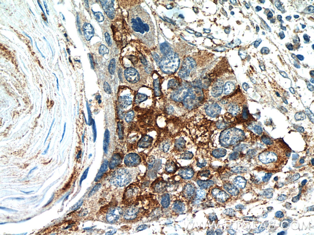 Immunohistochemistry (IHC) staining of human cervical cancer tissue using Cyclin B2 Polyclonal antibody (21644-1-AP)