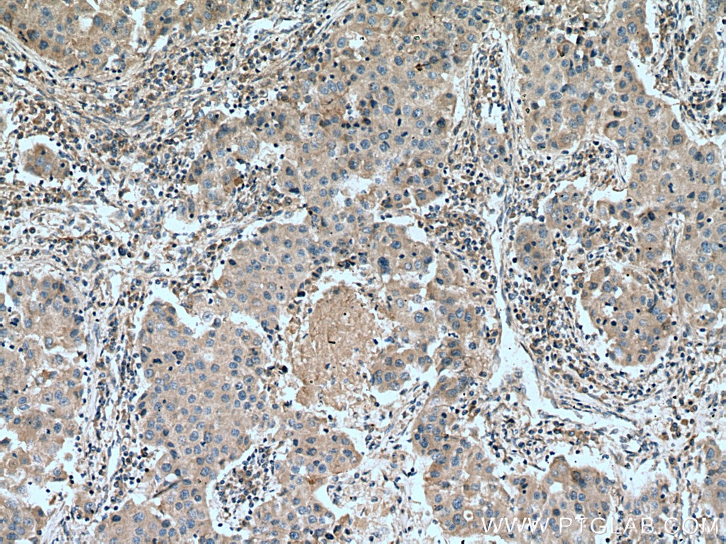 Immunohistochemistry (IHC) staining of human breast cancer tissue using Cyclin B2 Monoclonal antibody (67726-1-Ig)