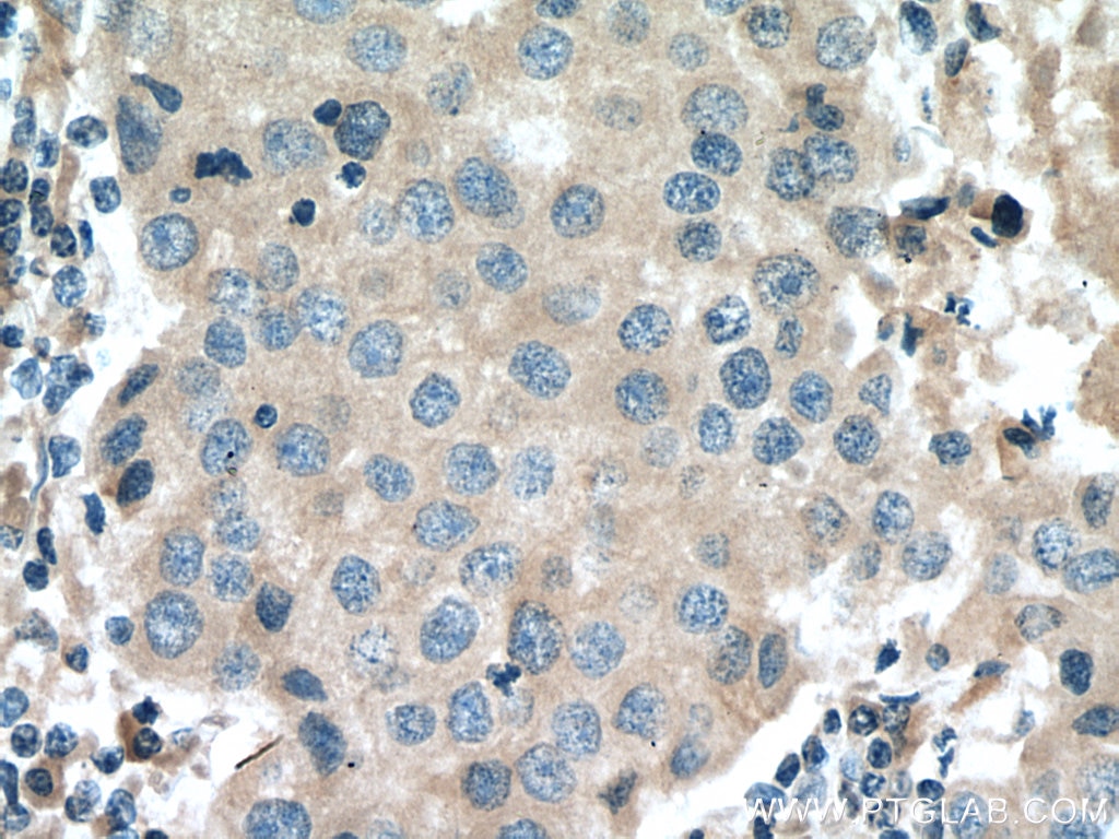 Immunohistochemistry (IHC) staining of human breast cancer tissue using Cyclin B2 Monoclonal antibody (67726-1-Ig)