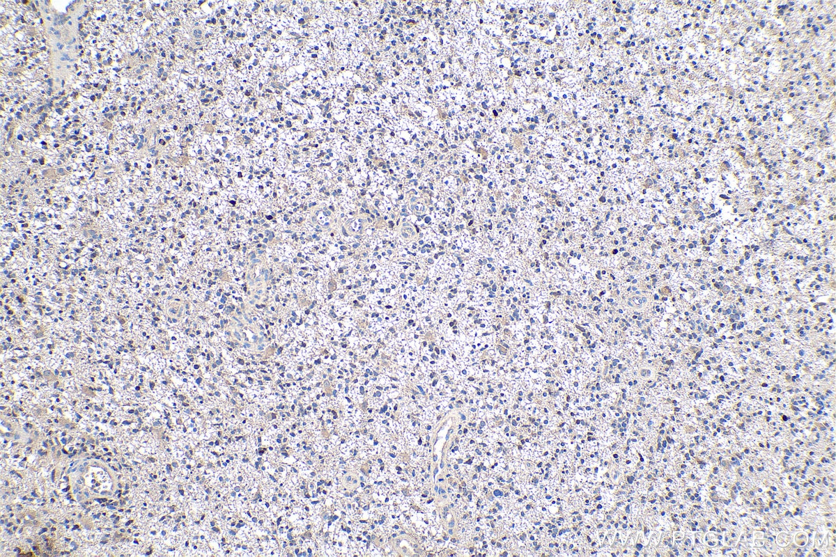 IHC staining of human gliomas using 10934-1-AP