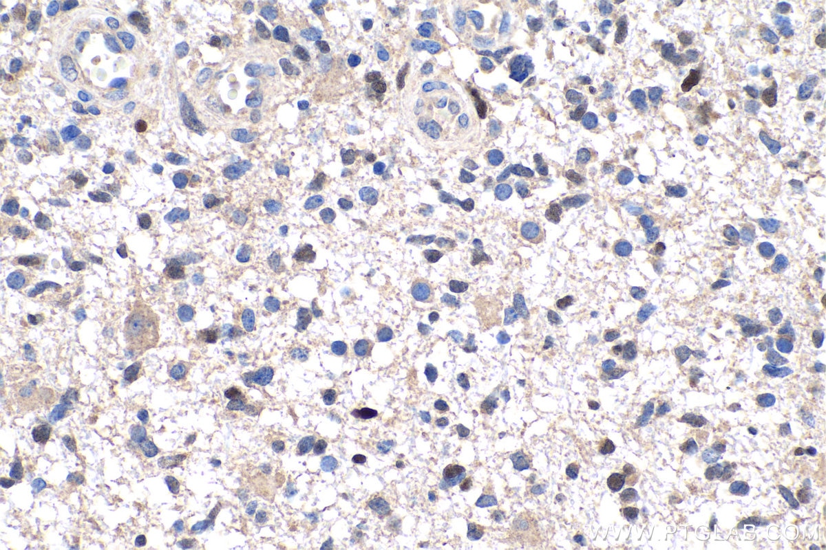 IHC staining of human gliomas using 10934-1-AP