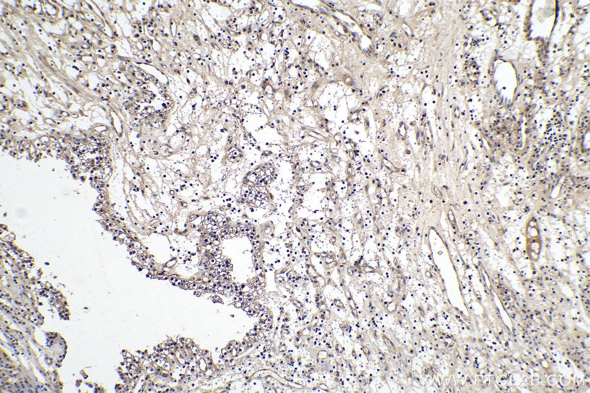 Immunohistochemistry (IHC) staining of human renal cell carcinoma tissue using Cyclin D2 Polyclonal antibody (10934-1-AP)