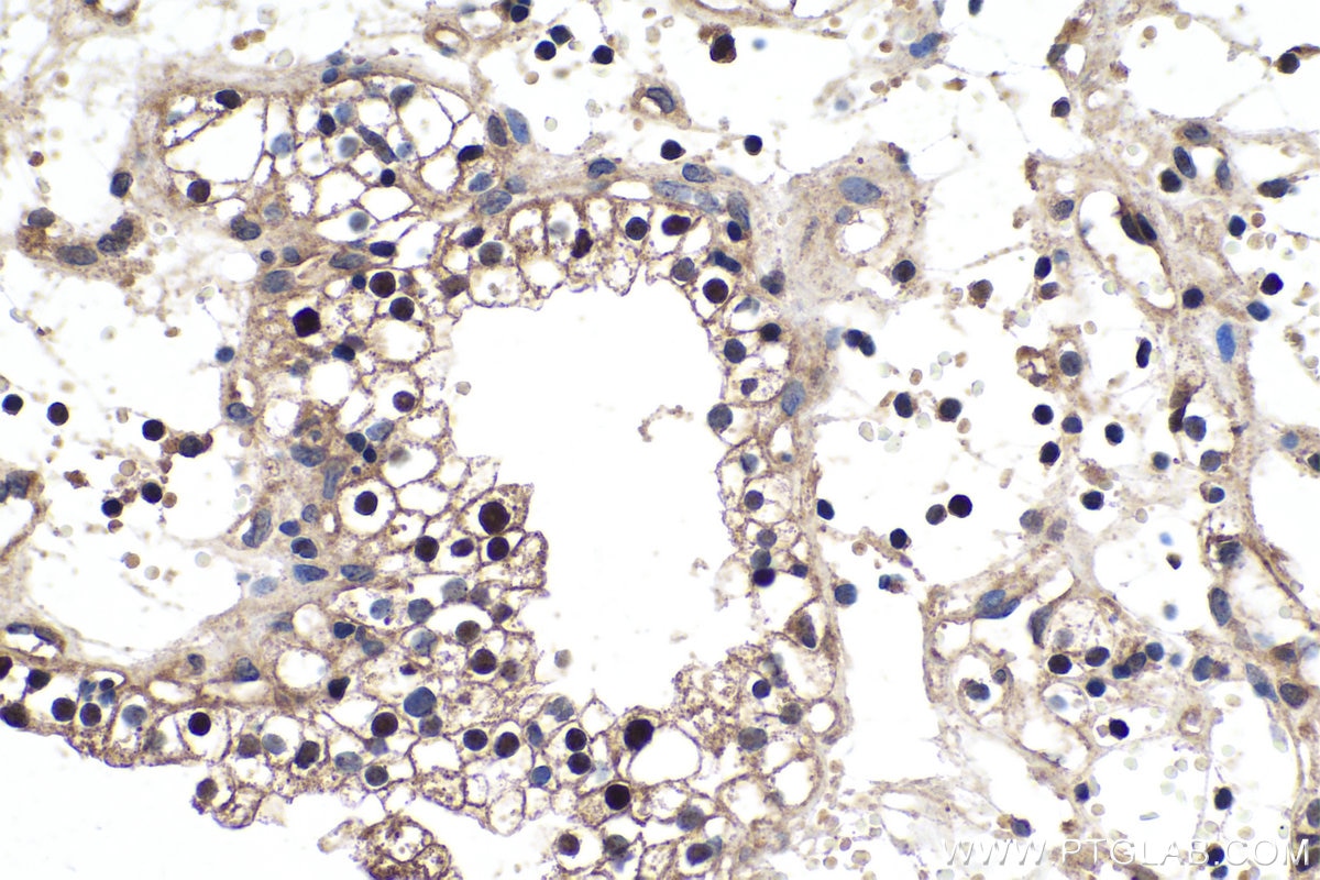 Immunohistochemistry (IHC) staining of human renal cell carcinoma tissue using Cyclin D2 Polyclonal antibody (10934-1-AP)