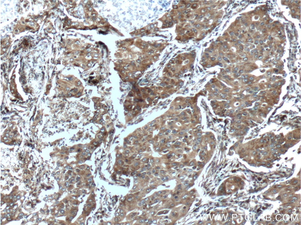 Immunohistochemistry (IHC) staining of human lung cancer tissue using CCNDBP1 Polyclonal antibody (12363-1-AP)