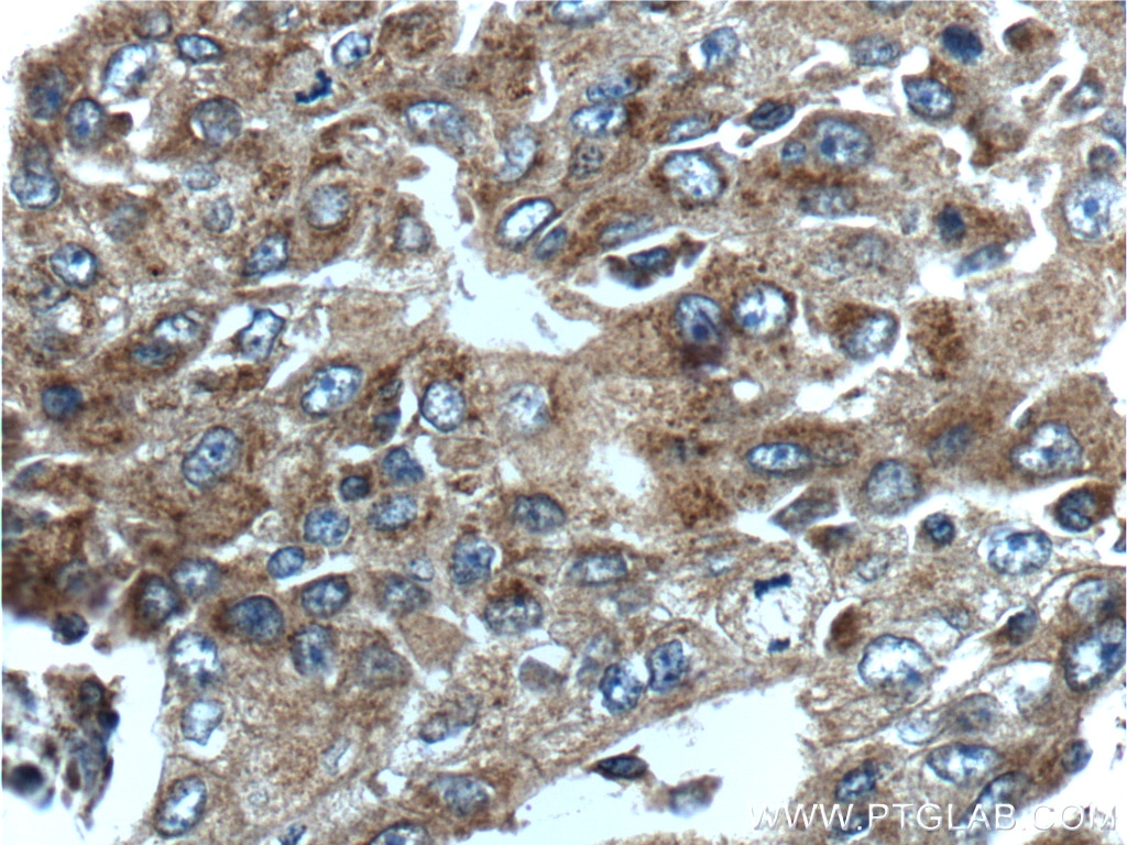 Immunohistochemistry (IHC) staining of human lung cancer tissue using CCNDBP1 Polyclonal antibody (12363-1-AP)