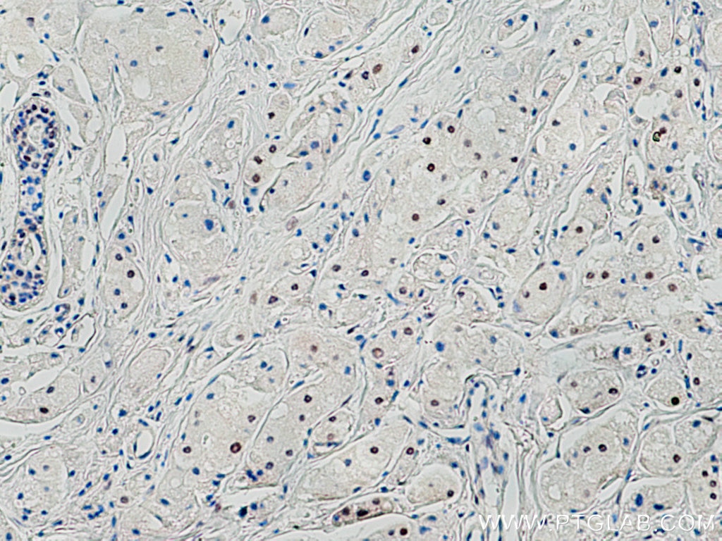 Immunohistochemistry (IHC) staining of human breast cancer tissue using Cyclin E2 Polyclonal antibody (11935-1-AP)
