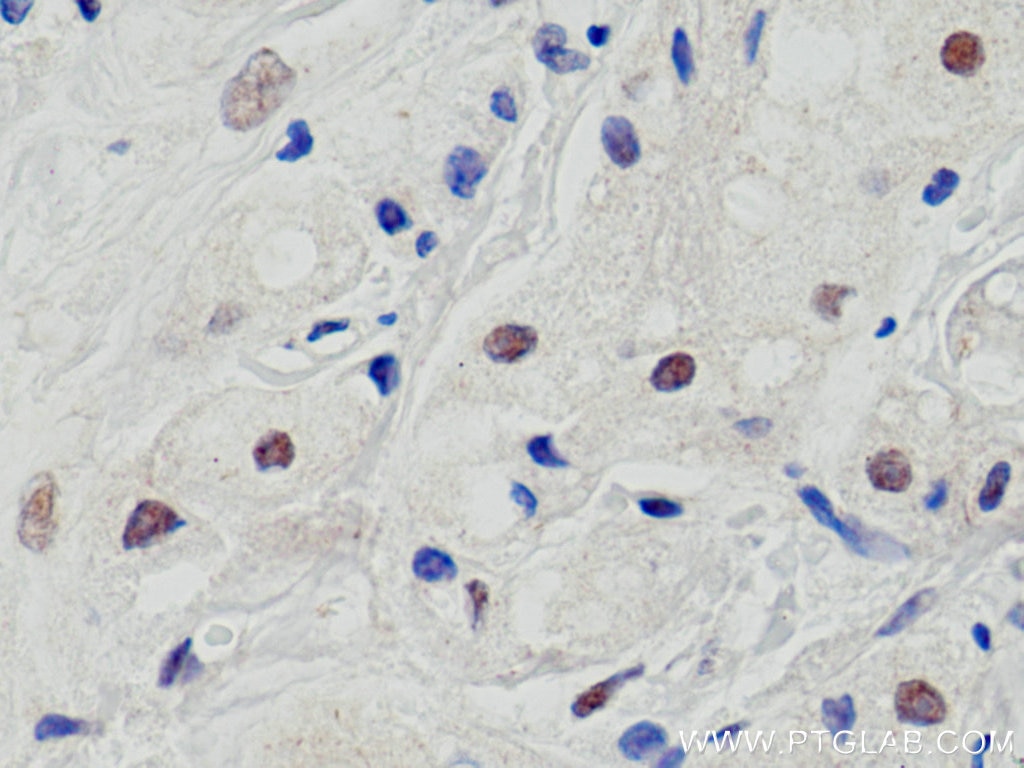 Immunohistochemistry (IHC) staining of human breast cancer tissue using Cyclin E2 Polyclonal antibody (11935-1-AP)