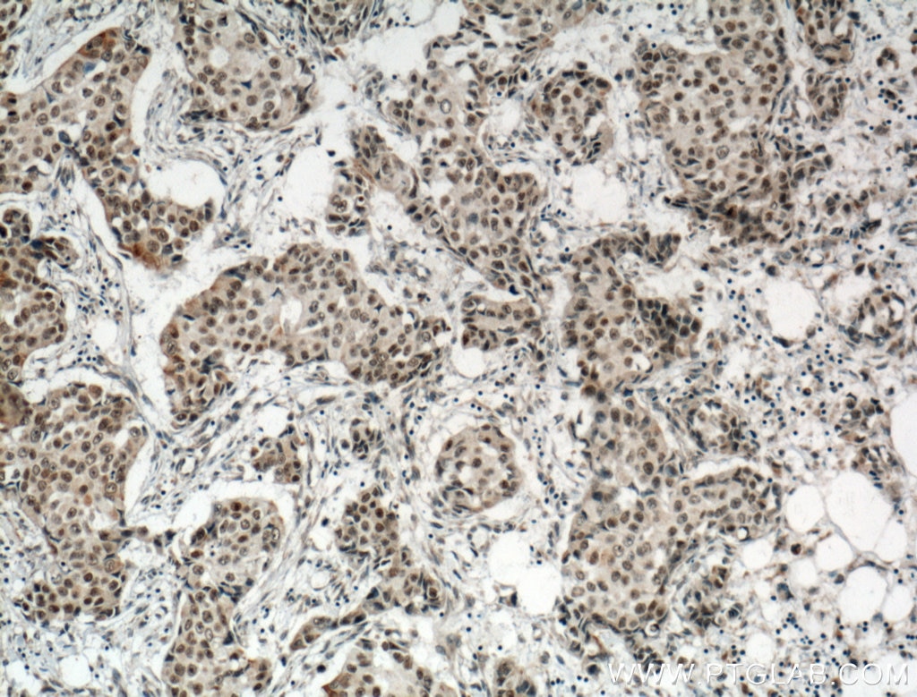 Immunohistochemistry (IHC) staining of human breast cancer tissue using Cyclin G Polyclonal antibody (10897-1-AP)