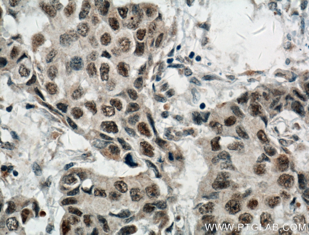 Immunohistochemistry (IHC) staining of human breast cancer tissue using Cyclin G Polyclonal antibody (10897-1-AP)