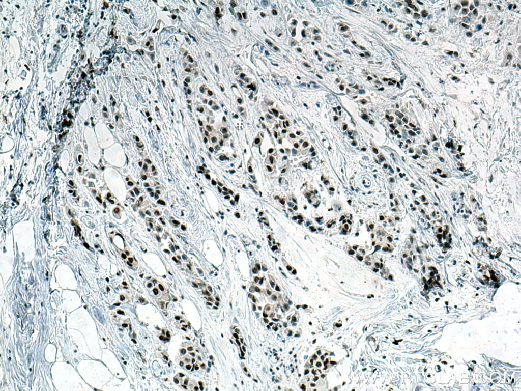 Immunohistochemistry (IHC) staining of human breast cancer tissue using Cyclin H Polyclonal antibody (10718-1-AP)