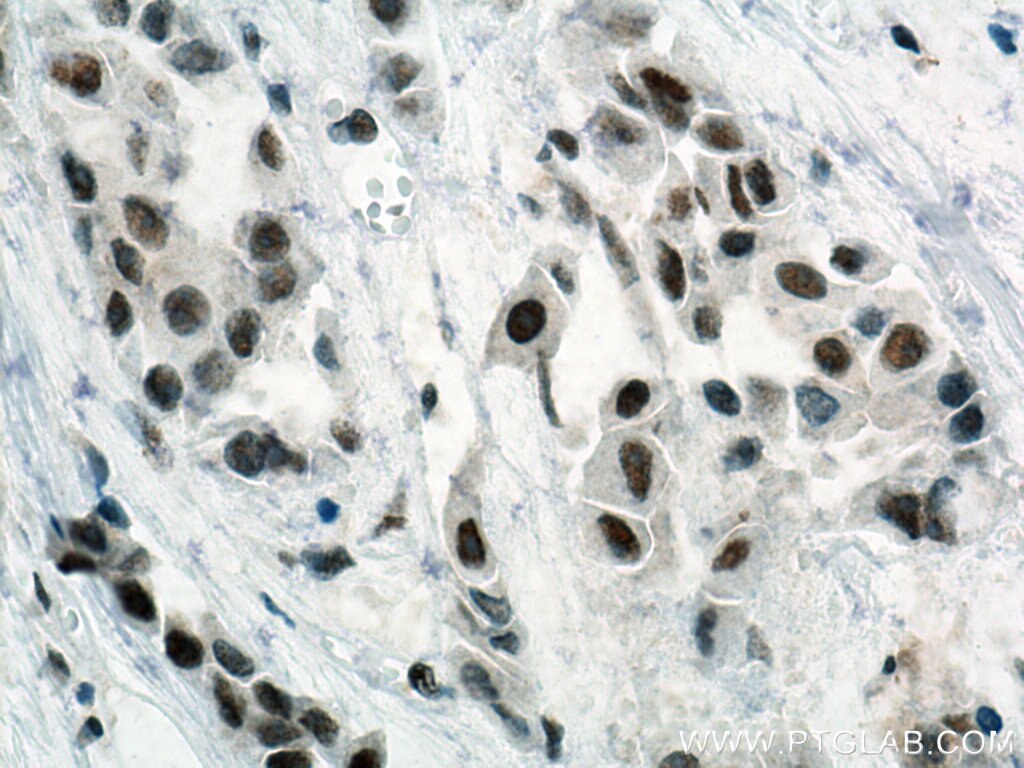 Immunohistochemistry (IHC) staining of human breast cancer tissue using Cyclin H Polyclonal antibody (10718-1-AP)