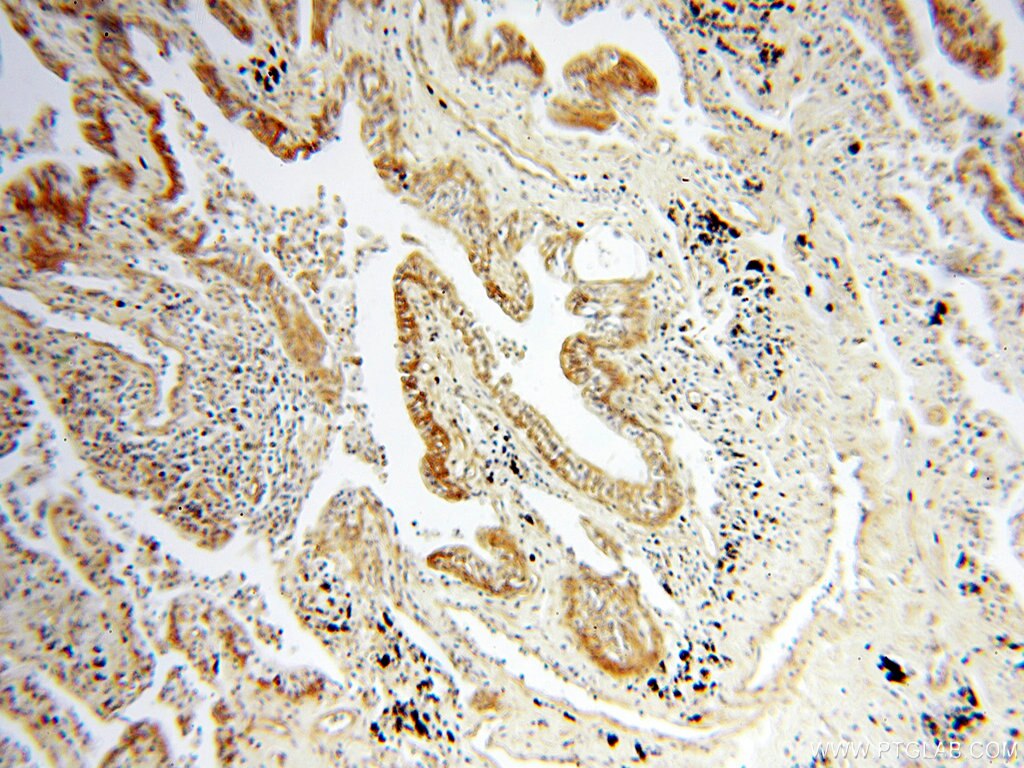 Immunohistochemistry (IHC) staining of human lung cancer tissue using CCNI2 Polyclonal antibody (18822-1-AP)