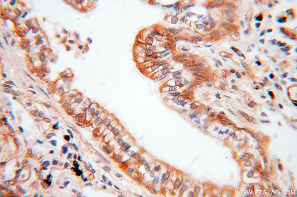 Immunohistochemistry (IHC) staining of human lung cancer tissue using CCNI2 Polyclonal antibody (18822-1-AP)