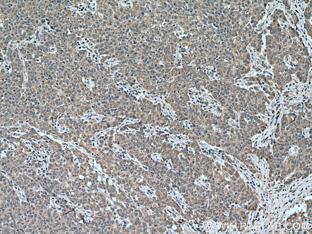 Immunohistochemistry (IHC) staining of human stomach cancer tissue using CCPG1 Polyclonal antibody (13861-1-AP)