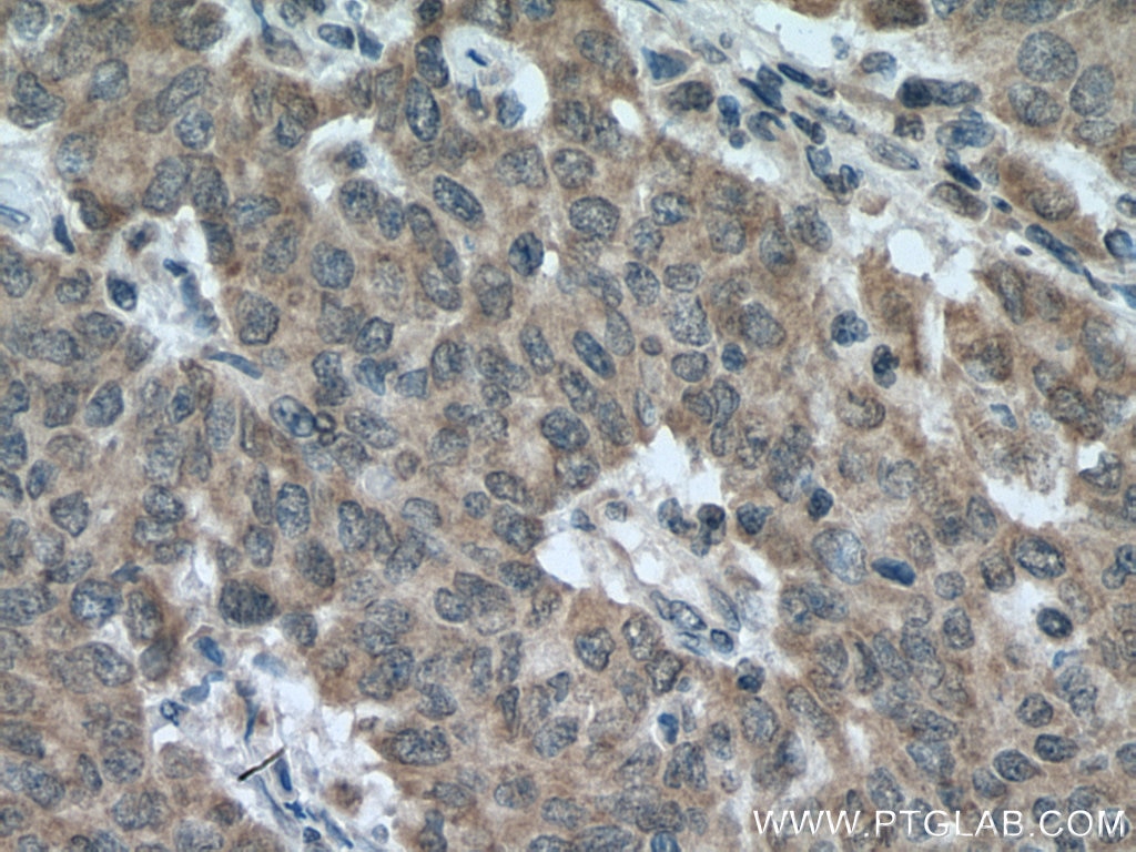 Immunohistochemistry (IHC) staining of human stomach cancer tissue using CCPG1 Polyclonal antibody (13861-1-AP)