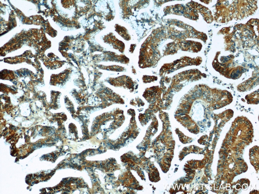 IHC staining of human ovary tumor using 16153-1-AP