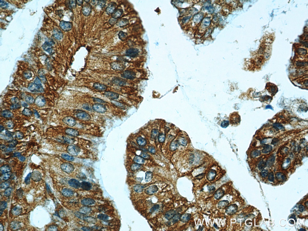 Immunohistochemistry (IHC) staining of human ovary tumor tissue using CCR2a-specific Polyclonal antibody (16153-1-AP)