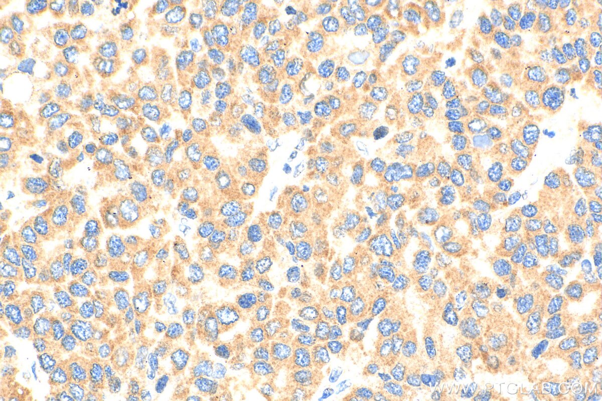 Immunohistochemistry (IHC) staining of human liver cancer tissue using CCR2b-specific Polyclonal antibody (16154-1-AP)