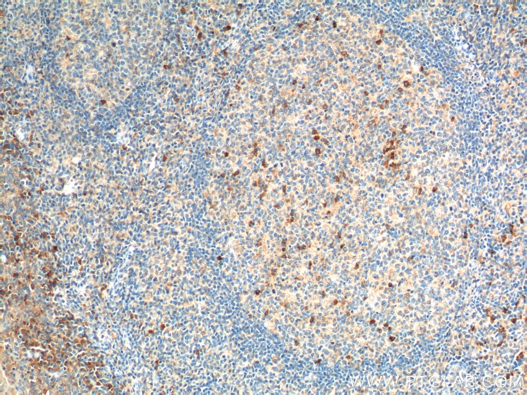 Immunohistochemistry (IHC) staining of human tonsillitis tissue using CCR3 Polyclonal antibody (22351-1-AP)